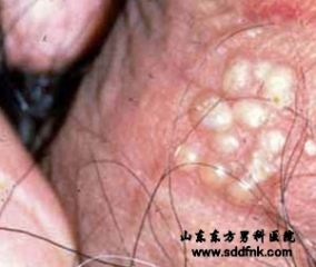生殖器疱疹的症状有哪些？